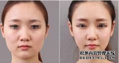面部吸脂多久能消肿？