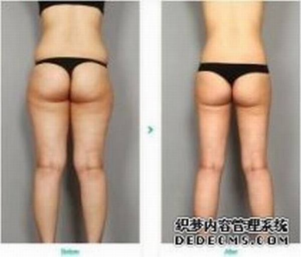 吸脂瘦大腿效果怎么样？