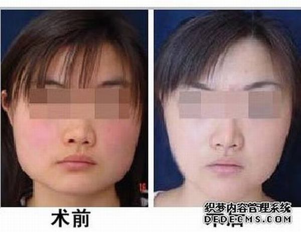 下颌角切除手术价格多少钱？下颌角术后护理怎么做？