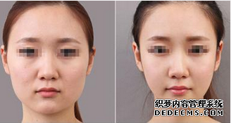 下颌角磨骨术恢复注意事项有哪些？
