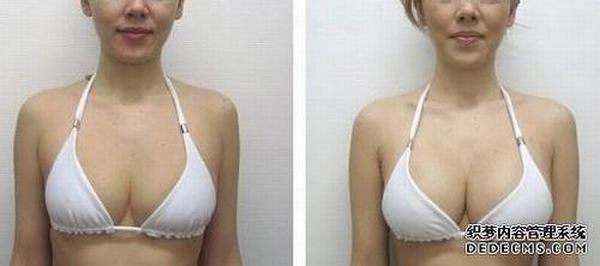 上海朴原辰隆胸怎么样？上海朴原辰隆胸多少钱？