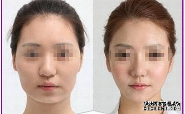颧骨颧弓整形术怎么样？颧骨颧弓整形多少钱？