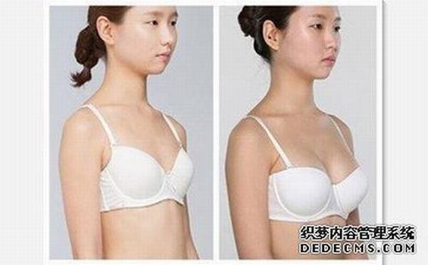上海伊美莱江华隆胸怎么样？价格多少钱？