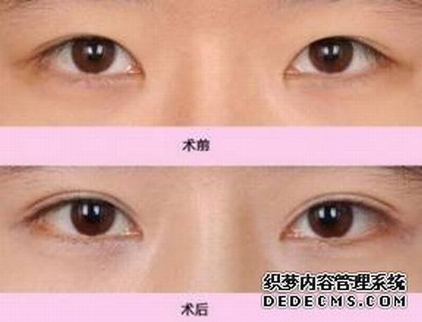 北京医院赵红艺割双眼皮怎么样?多少钱？