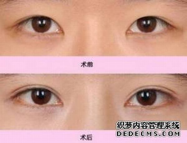 北京安贞李斌斌割双眼皮好吗？价格多少钱？