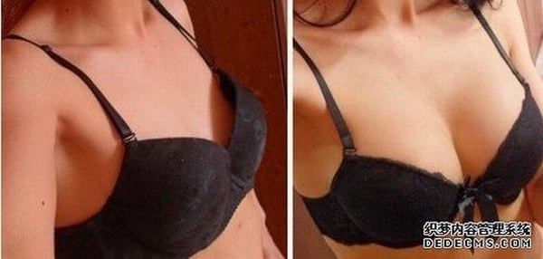 假体隆胸后能哺乳吗 假体隆胸会影响哺乳吗