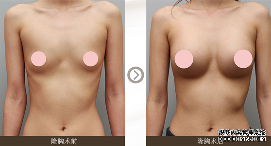 假体隆胸的材料有哪些 该如何选择