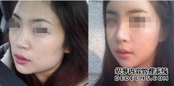 假体隆鼻材料有哪些 假体隆鼻什么材料好