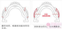 磨颧骨和颧骨内推手术有什么区别？哪种创伤小？