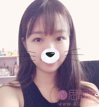 全切平行双眼皮案例
