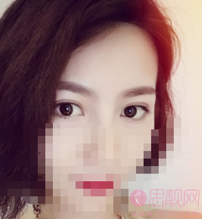 北京八大处陈文双眼皮怎么样