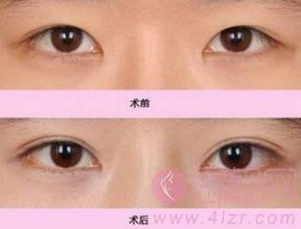 北京八大处于晓波割双眼皮怎么样