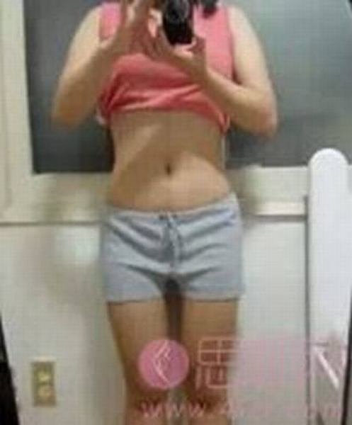腰腹部吸脂减肥手术前后对比 腰腹部吸脂案例分享