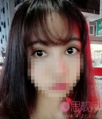 欧式大平行双眼皮案例