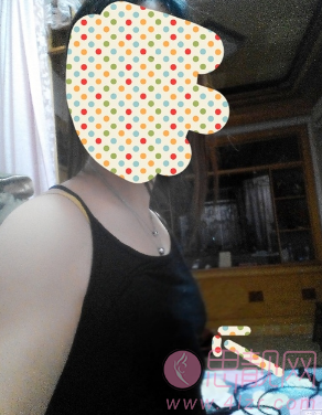 自体脂肪移植隆胸案例