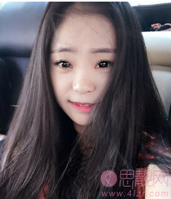 硅胶+软骨垫鼻尖综合隆鼻手术案例