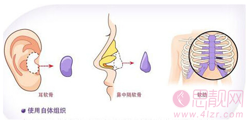 自体软骨隆鼻有什么后遗症