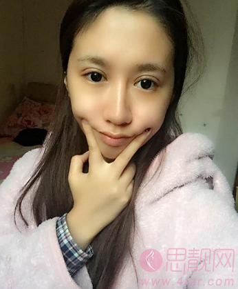 迷人的欧式双眼皮案例