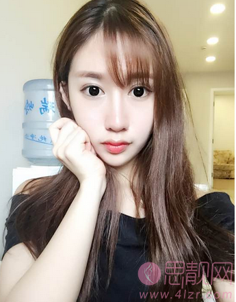 迷人的欧式双眼皮案例