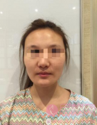 颧骨内推案例。瞬间变女神。