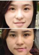 扇形双眼皮加开眼角手术案例