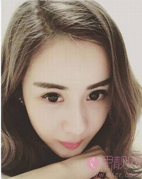 深圳北大李天石割双眼皮好不好