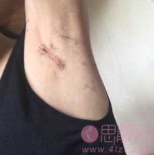 假体隆胸案例