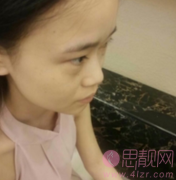 成都鼻部综合手术案例