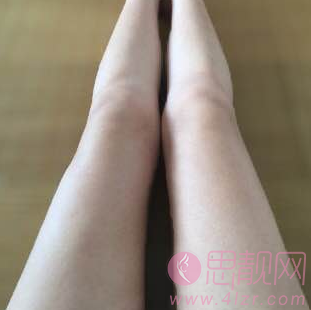 上大小腿吸脂手术案例恢复后