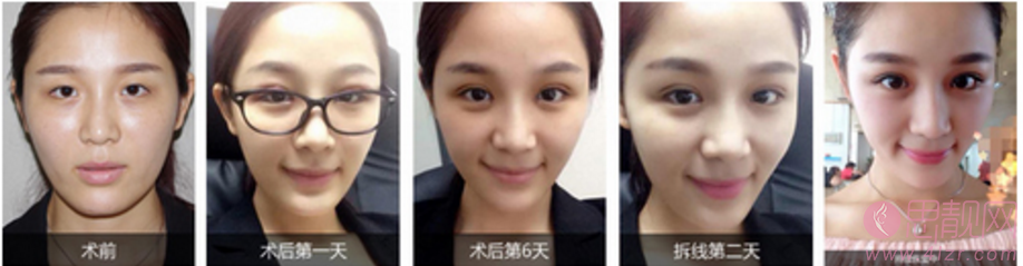 长沙爱思特张姣姣割双眼皮怎么样