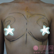偏瘦型自体隆胸手术案例。