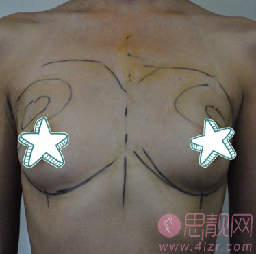 偏瘦型自体脂肪隆胸案例