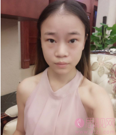 脂肪填充加隆鼻案例华丽转身