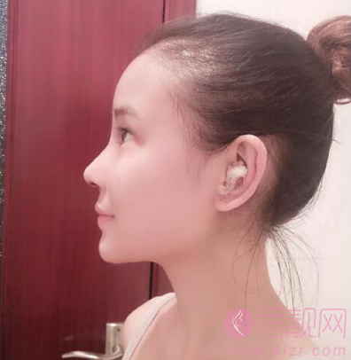 脂肪填充加上隆鼻案例