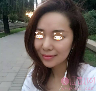 面部提升除皱抗衰老案例
