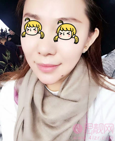 面部提升除皱案例