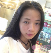 成都自体软骨隆鼻真实案例分析