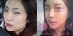 磨骨手术后皮肤会松弛下垂吗？