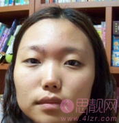颧骨下颌角加双眼皮术后一年
