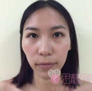 颧骨外凸怎么办？颧骨高降低手术案例
