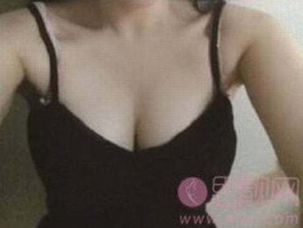 自体脂肪隆胸术前进行哪些准备