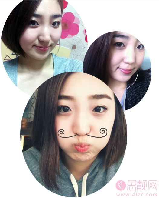 膨体隆鼻加鼻尖塑形路人变女神
