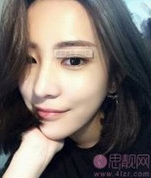 下颌角肥大一定要手术吗？