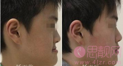 地包天矫正手术最佳的年龄是几岁？