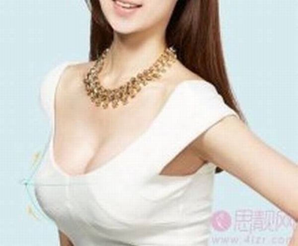 妙桃假体隆胸比普通假体隆胸的优点有哪些？