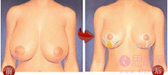 巨乳缩小手术不适合哪些人？
