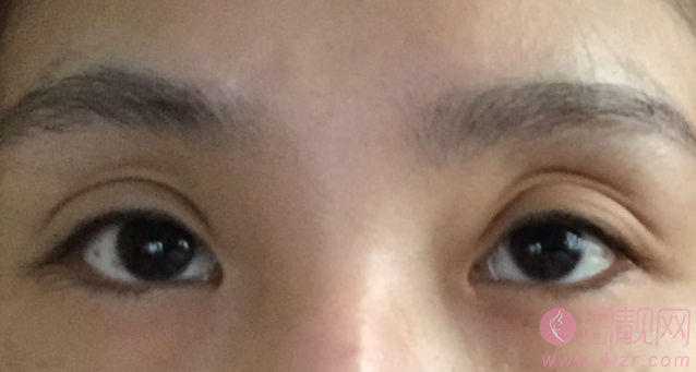 双眼皮可能的并发症有哪些