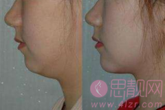 吸脂失败怎么办？如何修复？