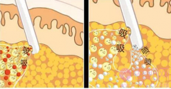水动力吸脂是什么？