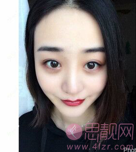 北京双眼皮加隆鼻变小仙女日记分享